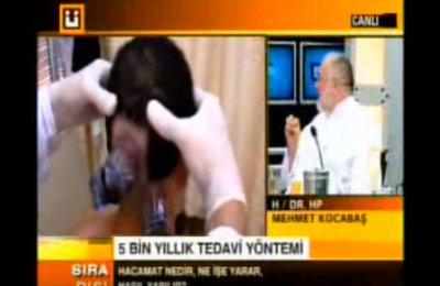 Dr. Mehmet Kocabaş Hacamat VİDEO 2